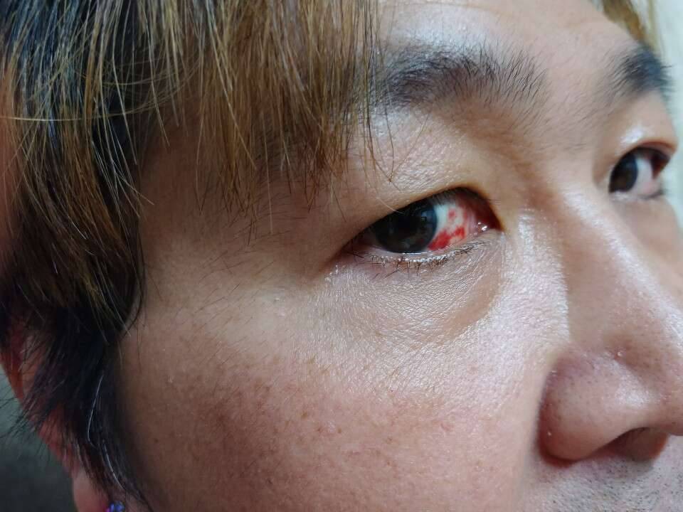 눈에 충혈이 왜 될까요 (커뮤니티 - 자유게시판)