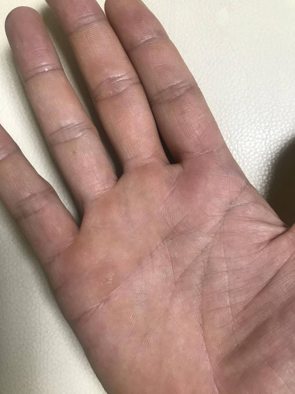 낚시 환자인증 훈장 “굳은살 제거” (커뮤니티 - 자유게시판)